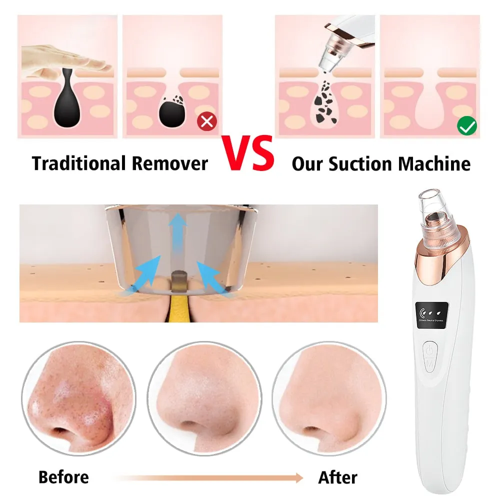 Beauty Electric Blackhead Remover